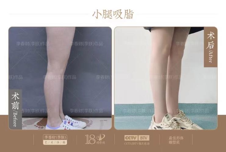 吸脂瘦腿常见问题解答，做吸脂瘦腿手术你应该知道这些